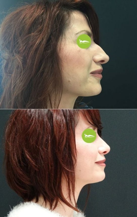 nose job italy