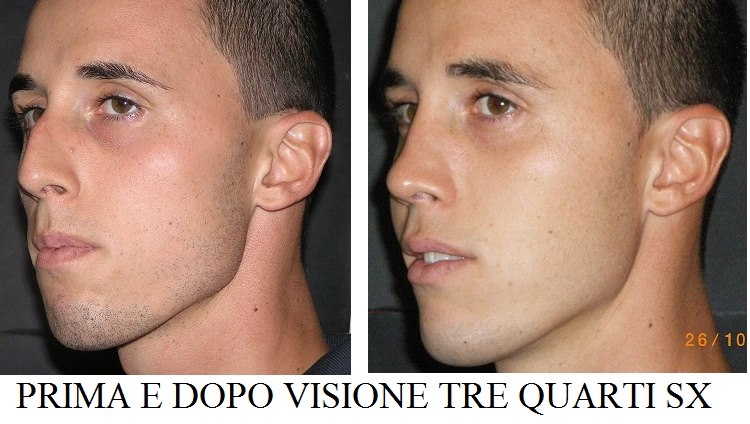 nose job italy